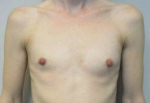 Breast Reconstruction Case 12 Before