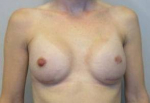 Breast Reconstruction Case 12 After