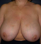 Breast Reduction Case 1 Before