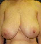 Breast Reduction Case 3 Before