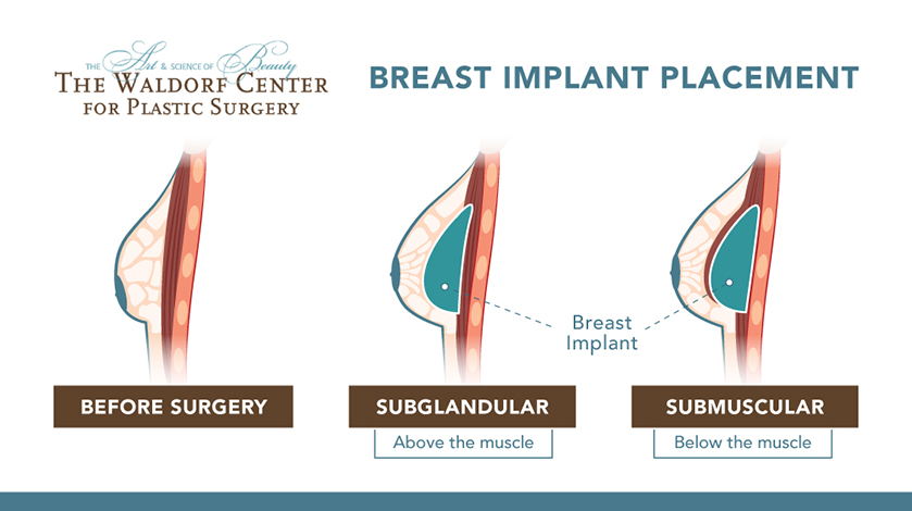 Silicone and saline breast implants can be positioned in one of two ways for breast augmentation at the Portland-based Waldorf Center for Plastic Surgery.