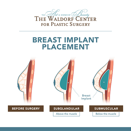 Silicone and saline breast implants can be positioned in one of two ways for breast augmentation at the Portland-based Waldorf Center for Plastic Surgery.