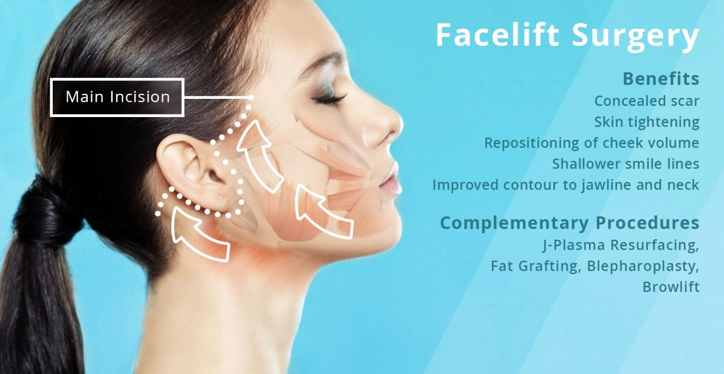 Facelift Surgery