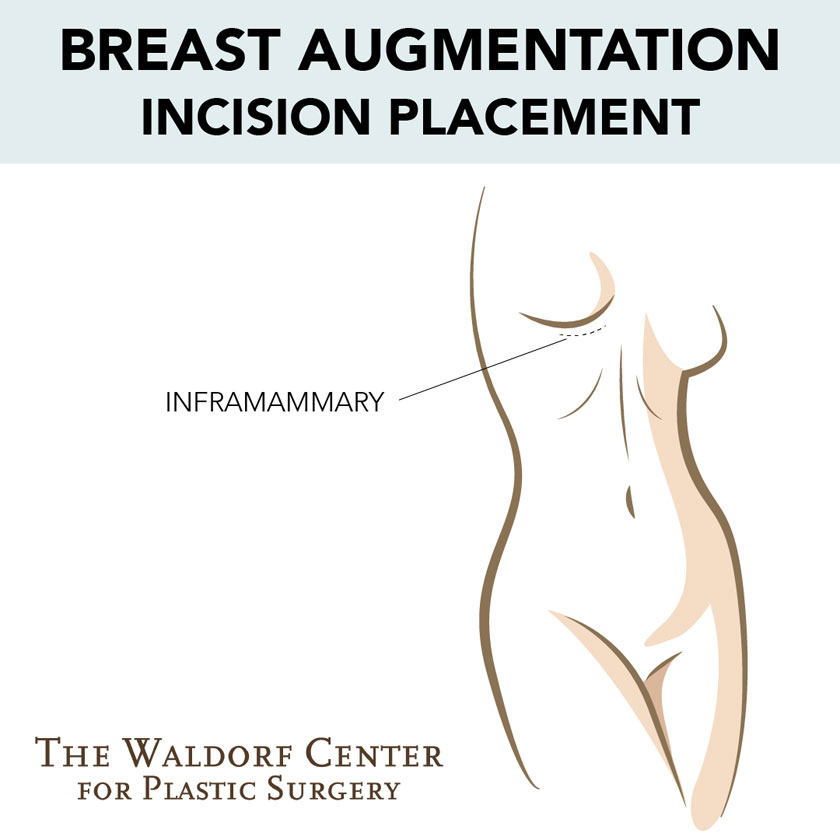 The Waldorf Center.s plastic surgeons use inframammary incisions for breast augmentation in Portland.
