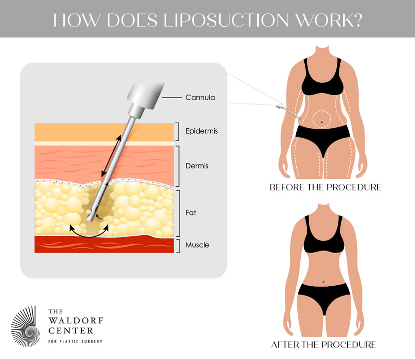 See how a cannula is positioned and works to reduce fat via liposuction at Portland’s Waldorf Center.