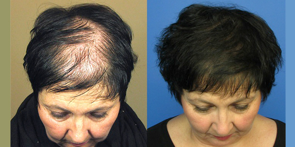 Hair Restoration | Portland | Waldorf Center for Plastic Surgery