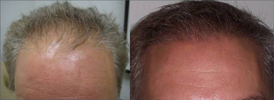 Hair Restoration | Portland | Waldorf Center for Plastic Surgery
