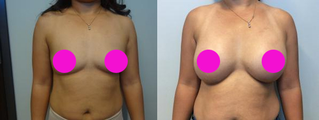 What is the Perfect Breast Implant Size?