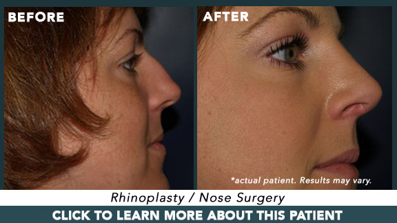 Rhinoplasty / Nose Surgery