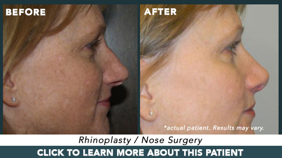 Rhinoplasty / Nose Surgery