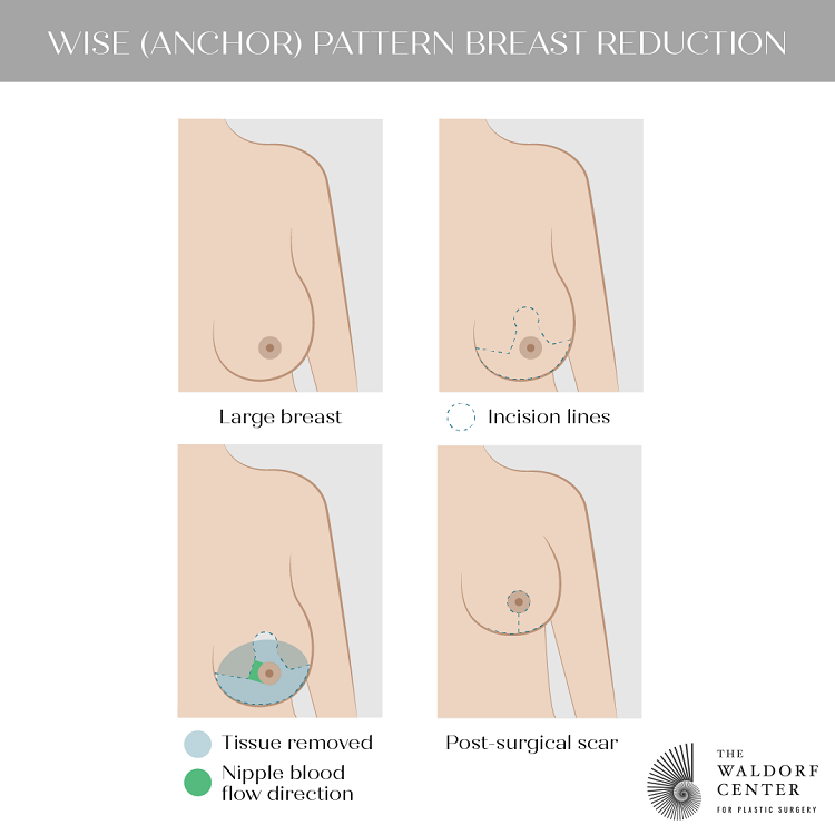See the variations in breast reduction surgery at Portland’s Waldorf Center.