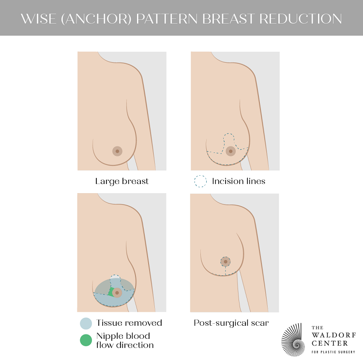 Breast Reduction, Portland