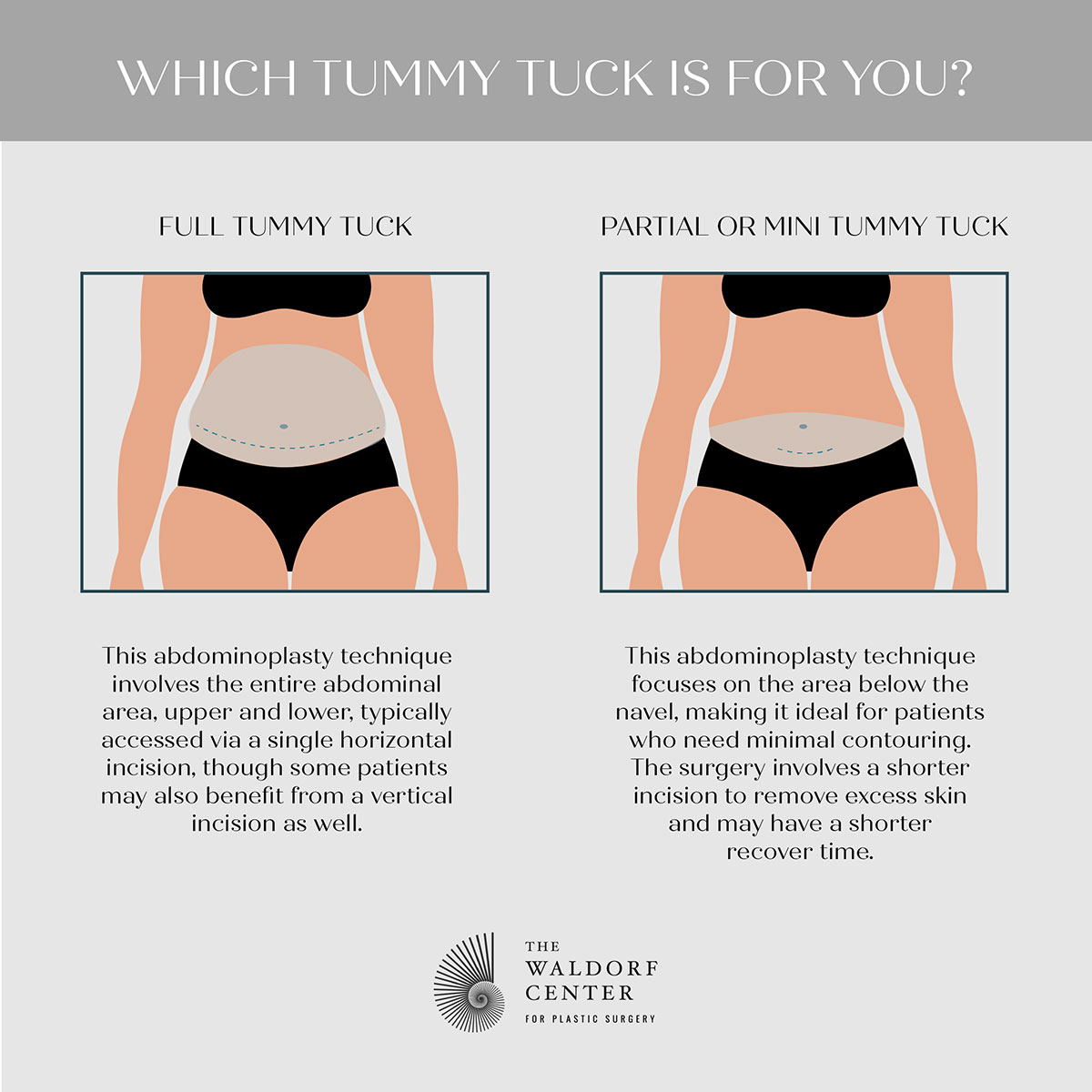 Learn the difference between a full and mini tummy tuck at Portland’s Waldorf Center.